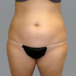 Smartlipo Vaser Lipo Before & After Patient #624