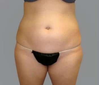 Smartlipo Vaser Lipo Before & After Patient #624
