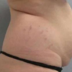 Smartlipo Vaser Lipo Before & After Patient #630