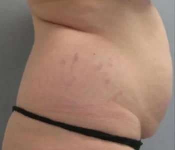Smartlipo Vaser Lipo Before & After Patient #630