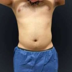 Smartlipo Vaser Lipo Before & After Patient #633