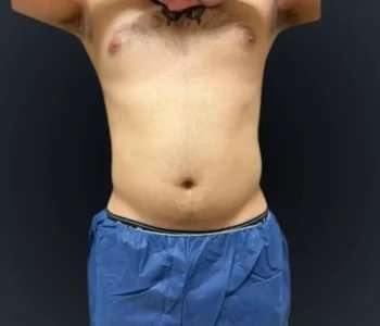 Smartlipo Vaser Lipo Before & After Patient #633