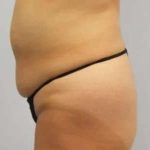 Smartlipo Vaser Lipo Before & After Patient #636