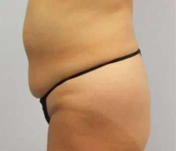 Smartlipo Vaser Lipo Before & After Patient #636