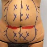 Smartlipo Vaser Lipo Before & After Patient #639