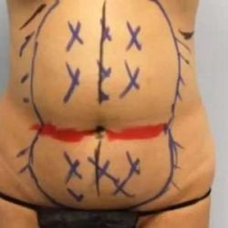 Smartlipo Vaser Lipo Before & After Patient #639