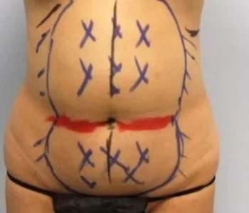 Smartlipo Vaser Lipo Before & After Patient #639