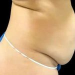 Smartlipo Vaser Lipo Before & After Patient #642
