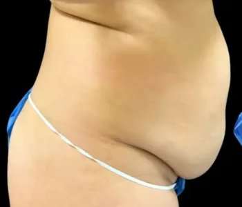 Smartlipo Vaser Lipo Before & After Patient #642