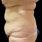 Smartlipo Vaser Lipo Before & After Patient #645