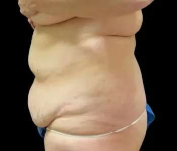 Smartlipo Vaser Lipo Before & After Patient #645