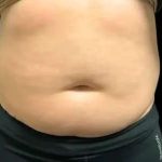 Smartlipo Vaser Lipo Before & After Patient #648