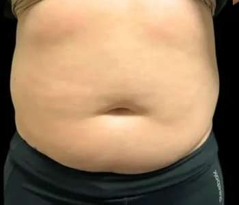Smartlipo Vaser Lipo Before & After Patient #648