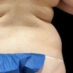 Smartlipo Vaser Lipo Before & After Patient #651