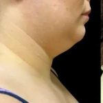 Smartlipo Vaser Lipo Before & After Patient #654