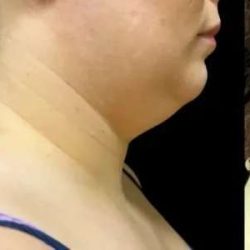 Smartlipo Vaser Lipo Before & After Patient #654