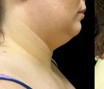Smartlipo Vaser Lipo Before & After Patient #654