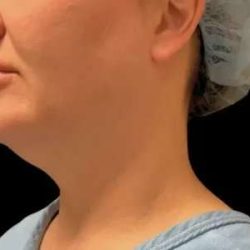 Smartlipo Vaser Lipo Before & After Patient #657