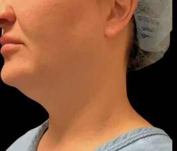 Smartlipo Vaser Lipo Before & After Patient #657