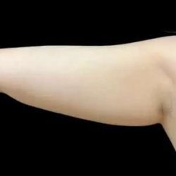 Smartlipo Vaser Lipo Before & After Patient #660