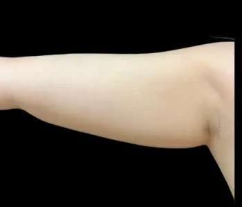 Smartlipo Vaser Lipo Before & After Patient #660