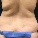 Smartlipo Vaser Lipo Before & After Patient #663