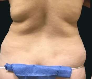 Smartlipo Vaser Lipo Before & After Patient #663