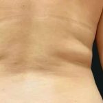 Smartlipo Vaser Lipo Before & After Patient #666