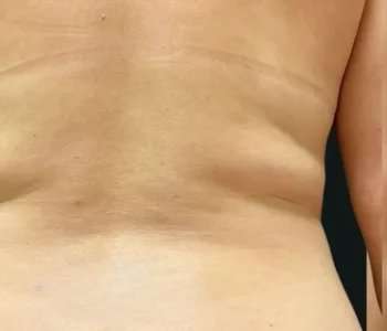 Smartlipo Vaser Lipo Before & After Patient #666
