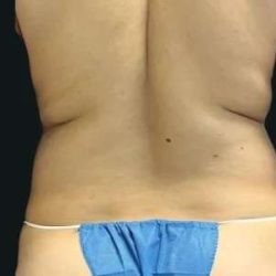 Smartlipo Vaser Lipo Before & After Patient #669