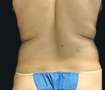 Smartlipo Vaser Lipo Before & After Patient #669