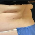 Smartlipo Vaser Lipo Before & After Patient #672