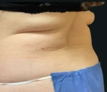 Smartlipo Vaser Lipo Before & After Patient #672