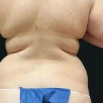 Smartlipo Vaser Lipo Before & After Patient #675