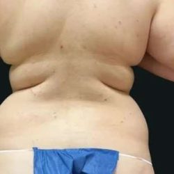Smartlipo Vaser Lipo Before & After Patient #675
