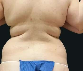 Smartlipo Vaser Lipo Before & After Patient #675