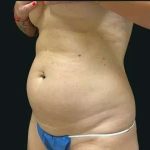 Smartlipo Vaser Lipo Before & After Patient #680
