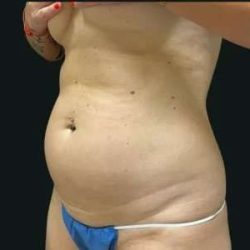 Smartlipo Vaser Lipo Before & After Patient #680