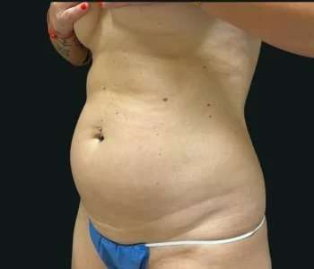Smartlipo Vaser Lipo Before & After Patient #680