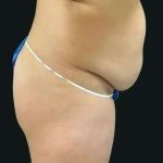 Smartlipo Vaser Lipo Before & After Patient #683