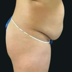 Smartlipo Vaser Lipo Before & After Patient #683