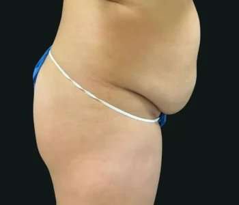 Smartlipo Vaser Lipo Before & After Patient #683