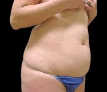 Smartlipo Vaser Lipo Before & After Patient #689
