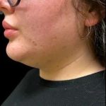 Smartlipo Vaser Lipo Before & After Patient #692