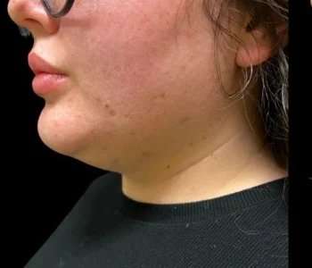 Smartlipo Vaser Lipo Before & After Patient #692