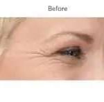 Botox Before & After Patient #701