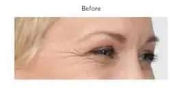 Botox Before & After Patient #701