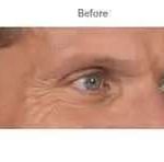 Botox Before & After Patient #704