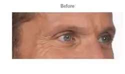 Botox Before & After Patient #704