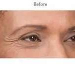 Botox Before & After Patient #707